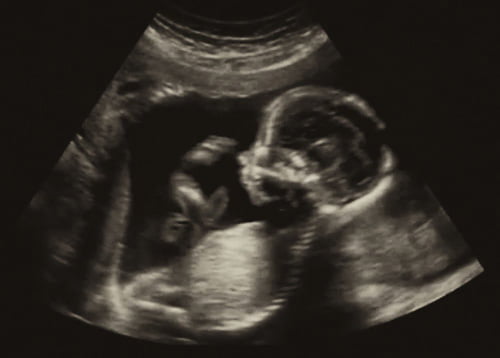 Understanding Why Ultrasounds are Required When You’re Considering Abortion
